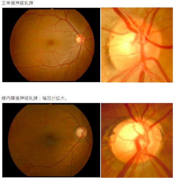 目の病気について ふなこし眼科